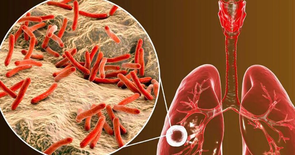 Métodos de tratamiento de la tuberculosis