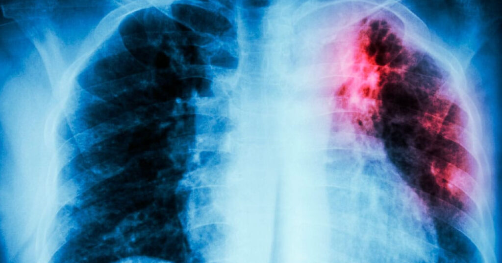 ¿Qué es la tuberculosis?