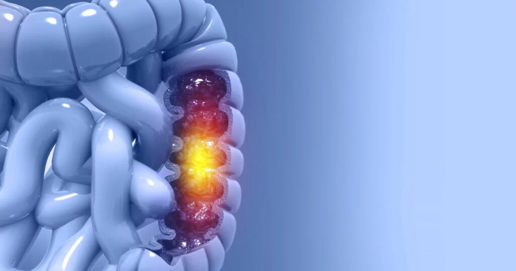 Cáncer de colon (intestino): Síntomas y tratamiento