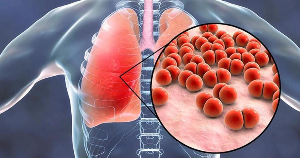 Qué es la neumonía (pulmonía), síntomas y tratamiento