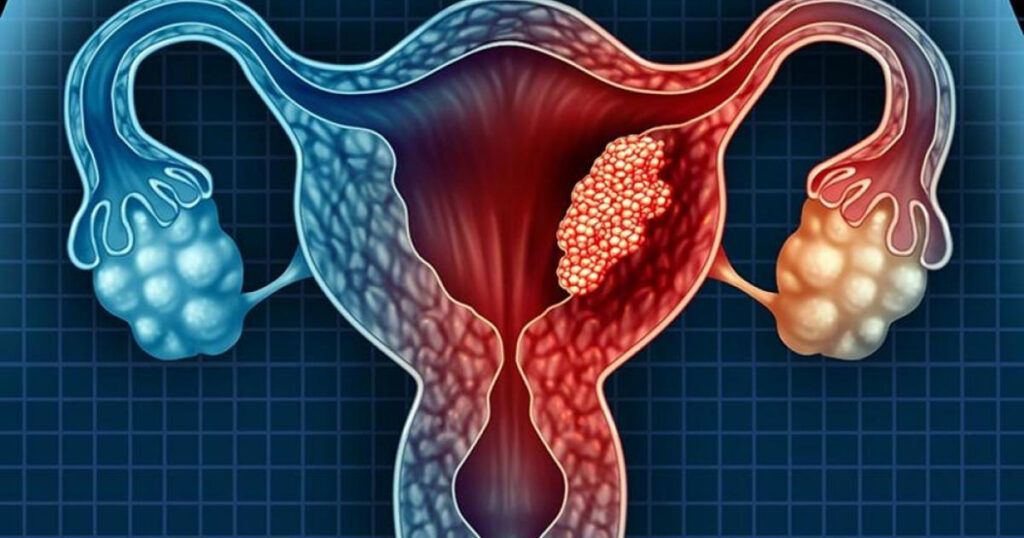 ¿Qué es el cáncer de endometrio?