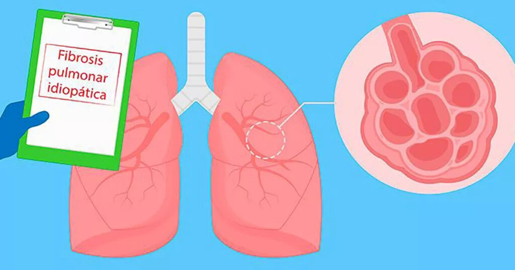 ¿Qué es la fibrosis pulmonar idiopática (FPI)?