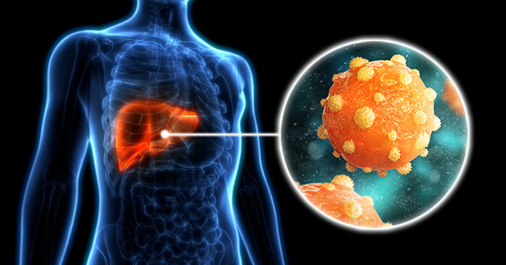 ¿Qué es la hepatitis A?